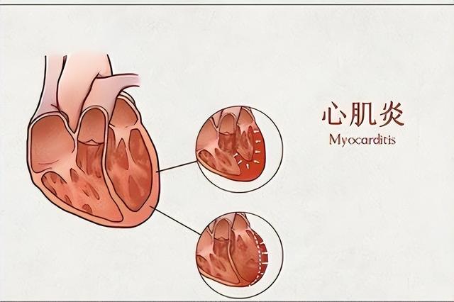 心肌炎的癥狀有哪些？心肌炎的主要變現(xiàn)癥狀有啥？